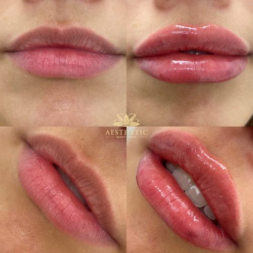 Aesthetic-lips-post-v01