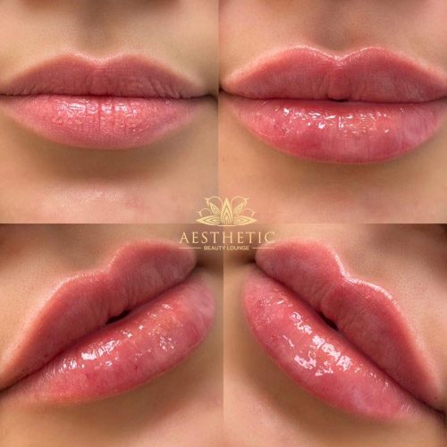 Aesthetic-lips-post-v04