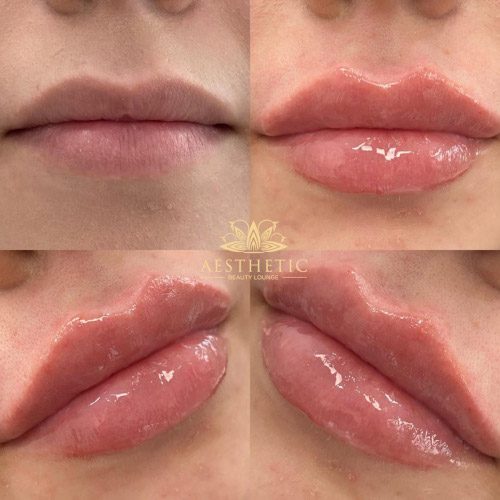 Aesthetic-lips-post-v06